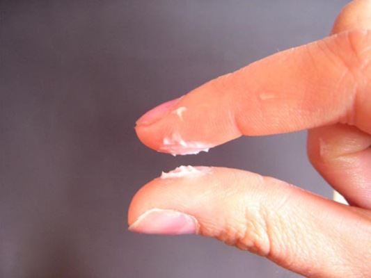 Dấu hiệu nấm âm đạo